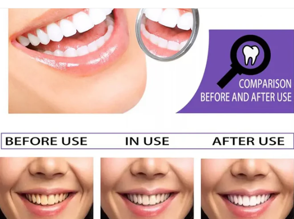 HiSmile V34 Teeth Whitening Serum | Colour Corrector | Stain Remover (Original)